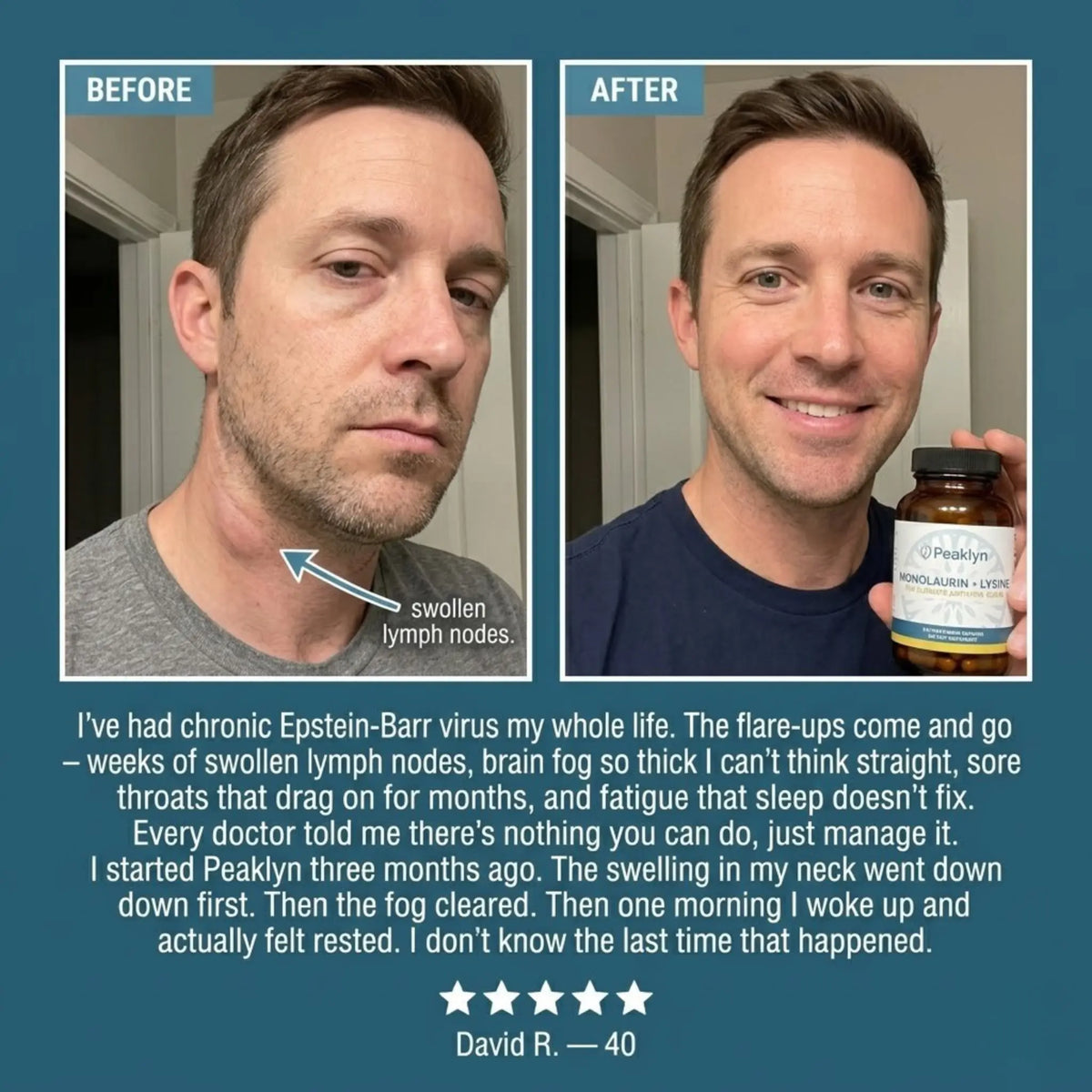 Peaklyn L-Lysine + Monolaurin For EBV