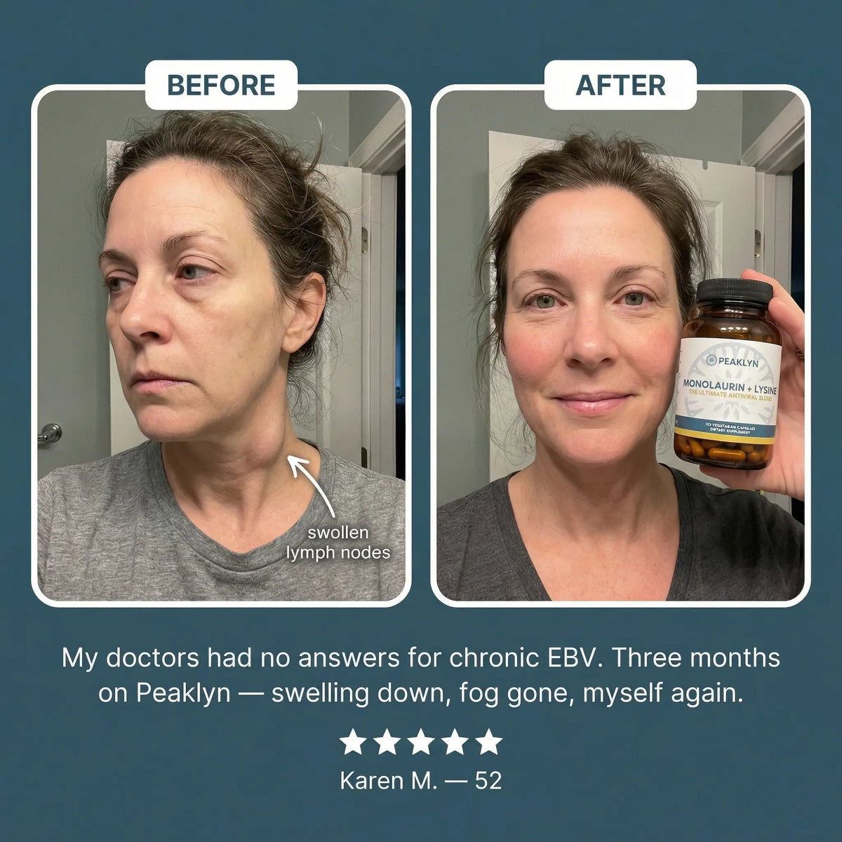 Peaklyn L-Lysine + Monolaurin For EBV